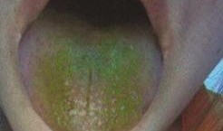 吃瓜吃了舌头出血,吃瓜过度致舌头出血的警示