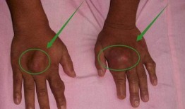 痛风吃角瓜行吗,角瓜的食疗作用解析